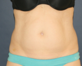 Feel Beautiful - Tummy-Tuck-Scar - Before Photo